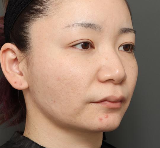 30代女性の顔の脂肪吸引  After 症例写真