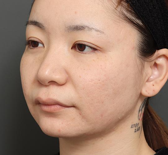 30代女性の顔の脂肪吸引  Before 症例写真