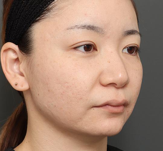 30代女性の顔の脂肪吸引  Before 症例写真