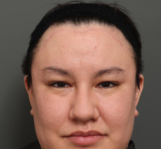 30代男性の額縮小 After 症例写真