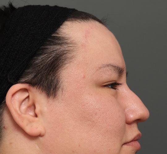 30代男性の額縮小 After 症例写真