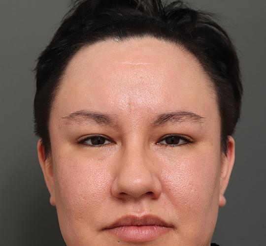 30代男性の額縮小 Before 症例写真