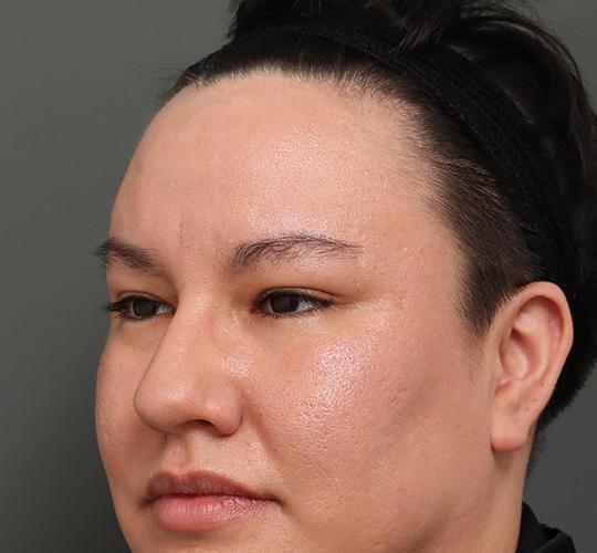 30代男性の額縮小 Before 症例写真