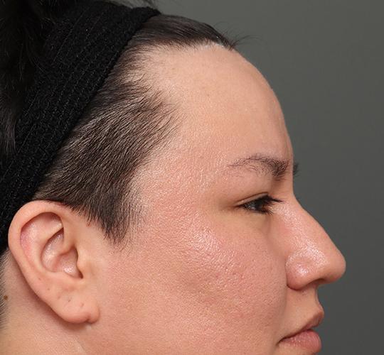 30代男性の額縮小 Before 症例写真