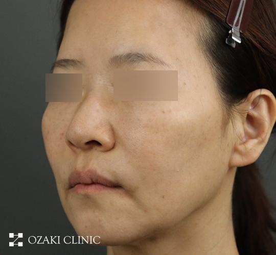 50代女性のジャルプロスーパーハイドロ After 症例写真