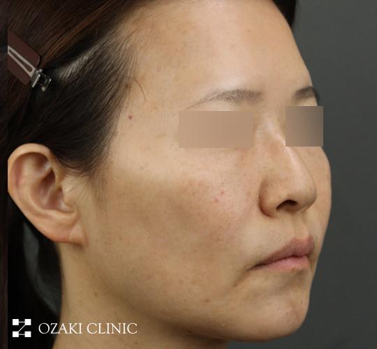 50代女性のジャルプロスーパーハイドロ After 症例写真