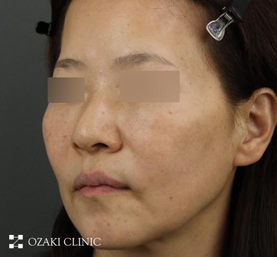 50代女性のジャルプロスーパーハイドロ Before 症例写真