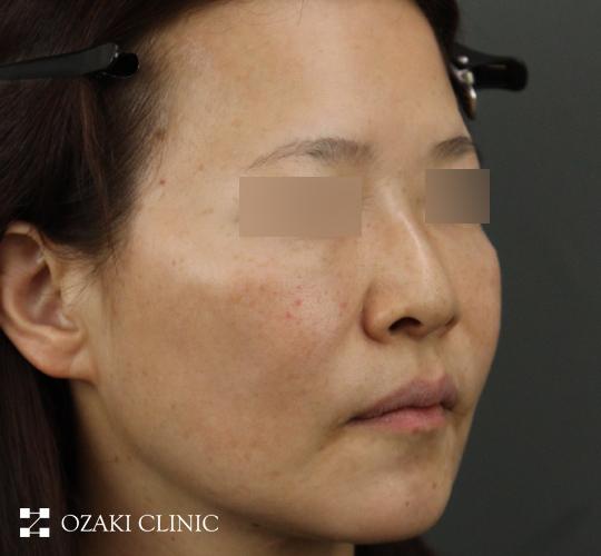 50代女性のジャルプロスーパーハイドロ Before 症例写真