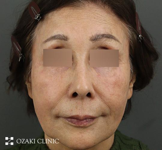 70代女性のジャルプロスーパーハイドロ After 症例写真