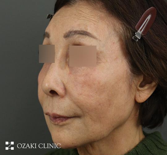 70代女性のジャルプロスーパーハイドロ After 症例写真