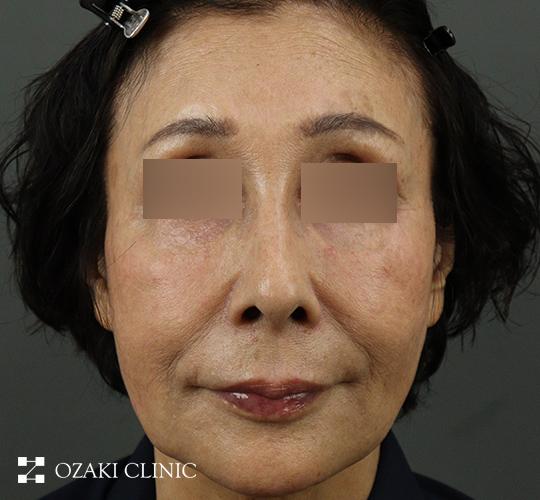 70代女性のジャルプロスーパーハイドロ Before 症例写真