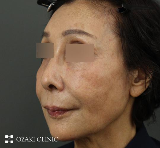 70代女性のジャルプロスーパーハイドロ Before 症例写真