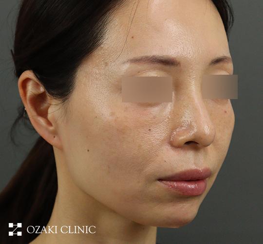 40代女性のヒアルロン酸注射(アゴ形成) After 症例写真