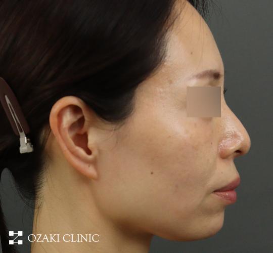 40代女性のヒアルロン酸注射(アゴ形成) After 症例写真
