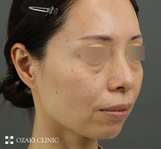 40代女性のヒアルロン酸注射(アゴ形成) Before 症例写真