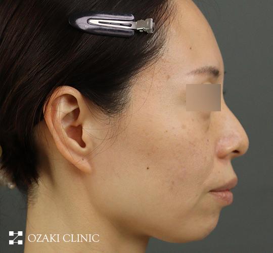 40代女性のヒアルロン酸注射(アゴ形成) Before 症例写真