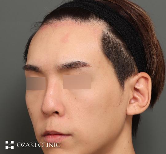 30代男性の額縮小 After 症例写真