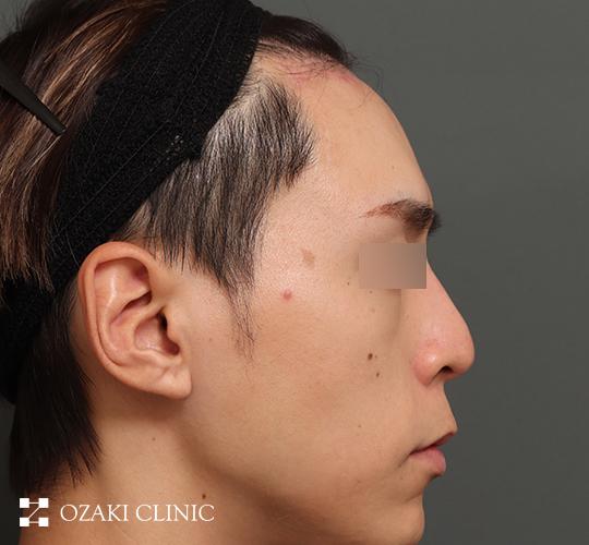 30代男性の額縮小 After 症例写真