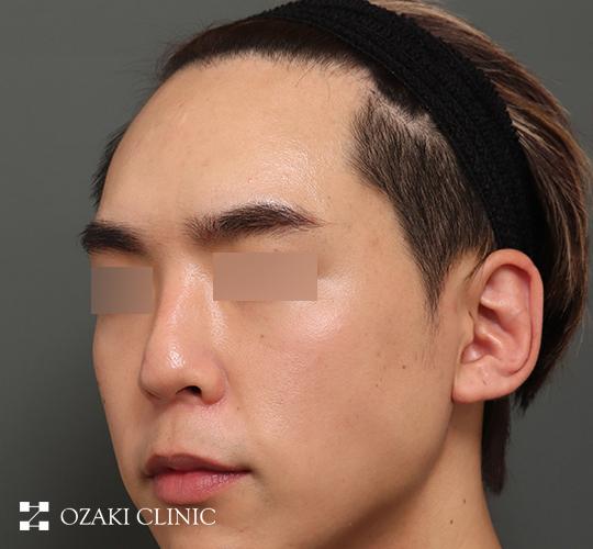 30代男性の額縮小 Before 症例写真