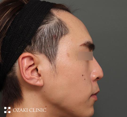 30代男性の額縮小 Before 症例写真