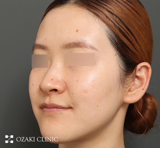 30代女性のジュべルック After 症例写真