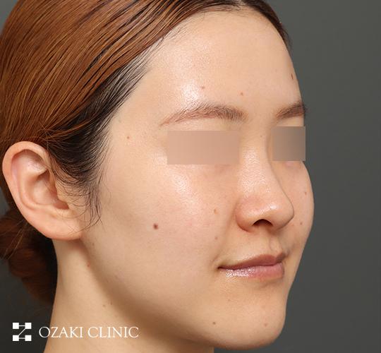 30代女性のジュべルック After 症例写真