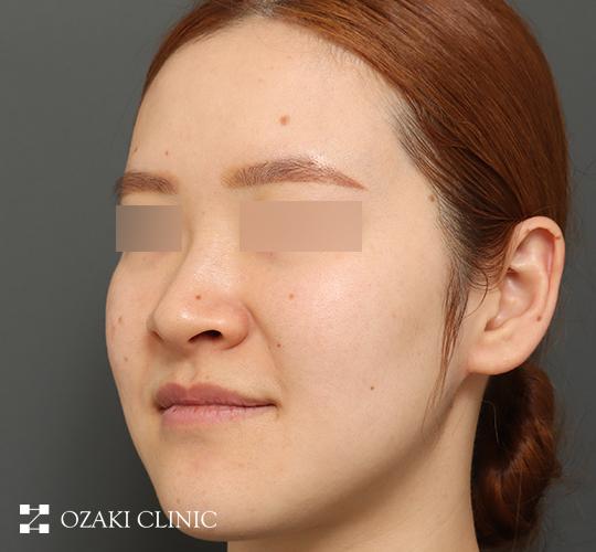 30代女性のジュべルック Before 症例写真