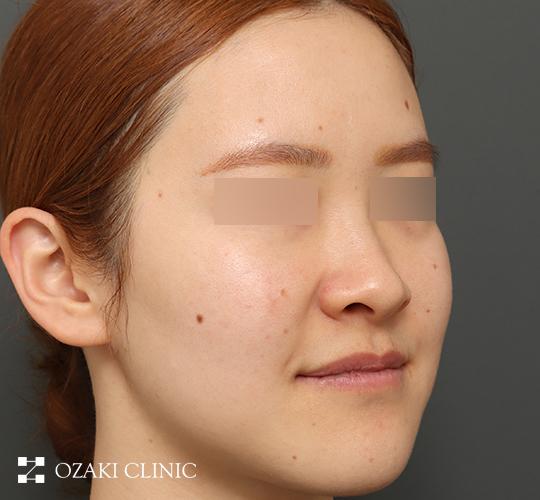 30代女性のジュべルック Before 症例写真