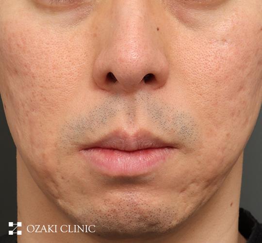 40代男性のキュアジェット(ニキビ跡) After 症例写真