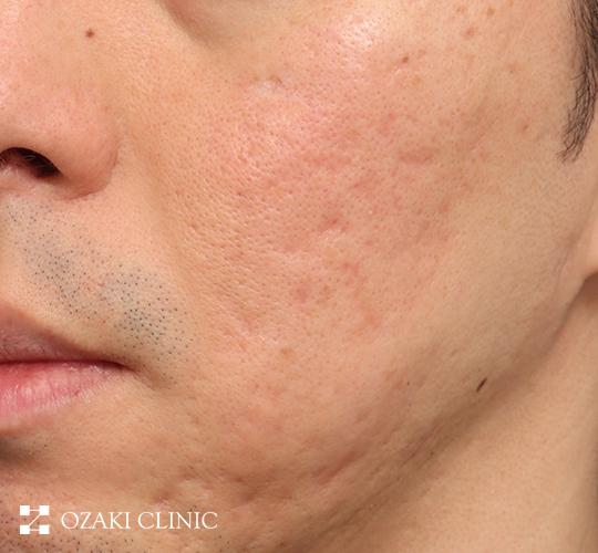 40代男性のキュアジェット(ニキビ跡) After 症例写真