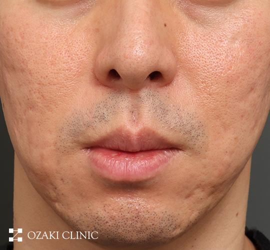 40代男性のキュアジェット(ニキビ跡) Before 症例写真