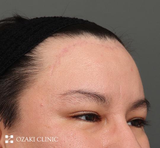 30代男性の生え際前進術 After 症例写真