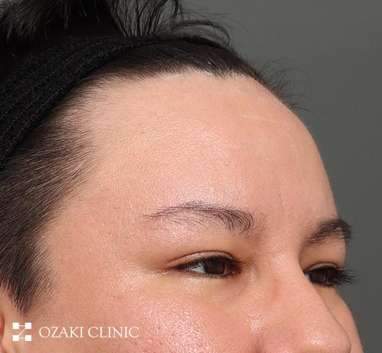 30代男性の生え際前進術 Before 症例写真