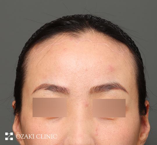 30代女性の額縮小 After 症例写真