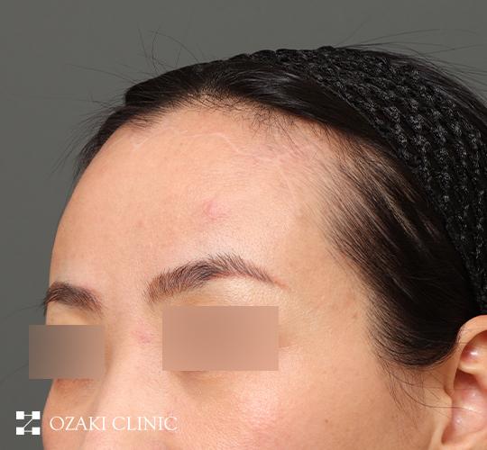 30代女性の生え際前進術 After 症例写真