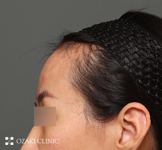 40代女性の生え際前進術 After 症例写真