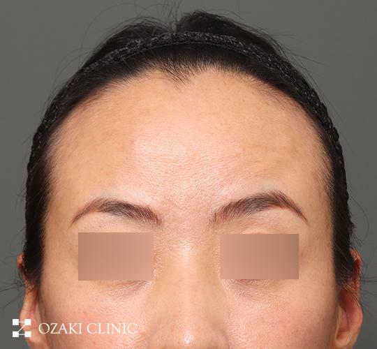 30代女性の額縮小 Before 症例写真