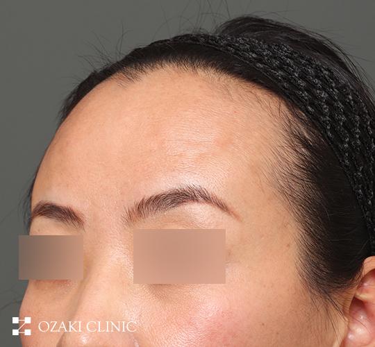30代女性の生え際前進術 Before 症例写真