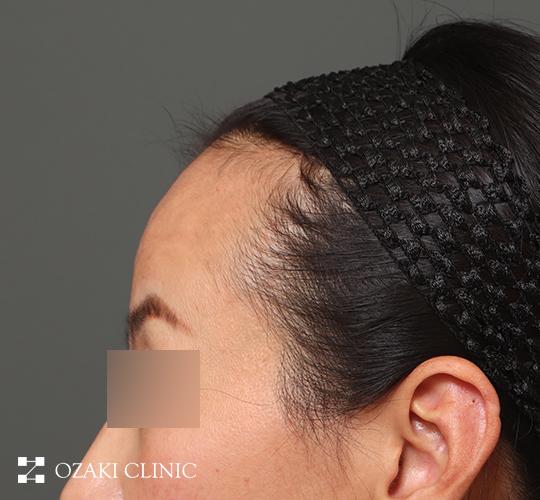 40代女性の生え際前進術 Before 症例写真