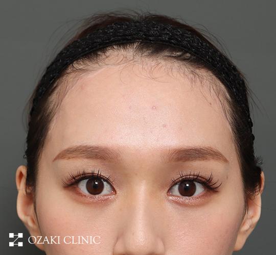 20代女性の額縮小 After 症例写真