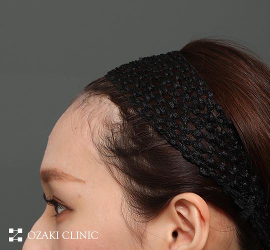 20代女性の額縮小 After 症例写真