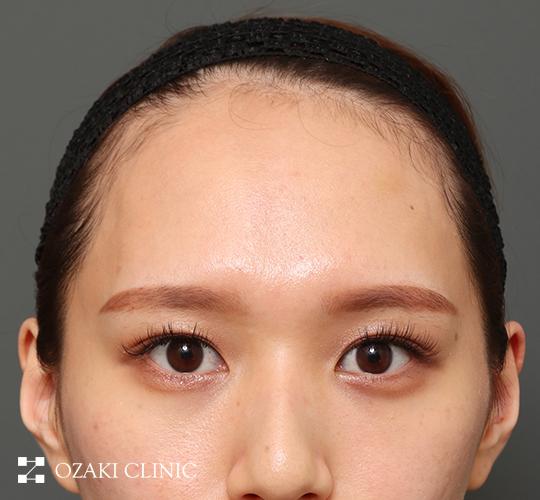 20代女性の額縮小 Before 症例写真