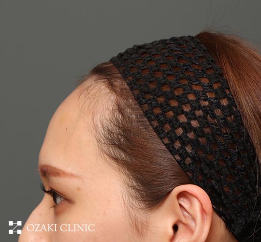 20代女性の額縮小 Before 症例写真