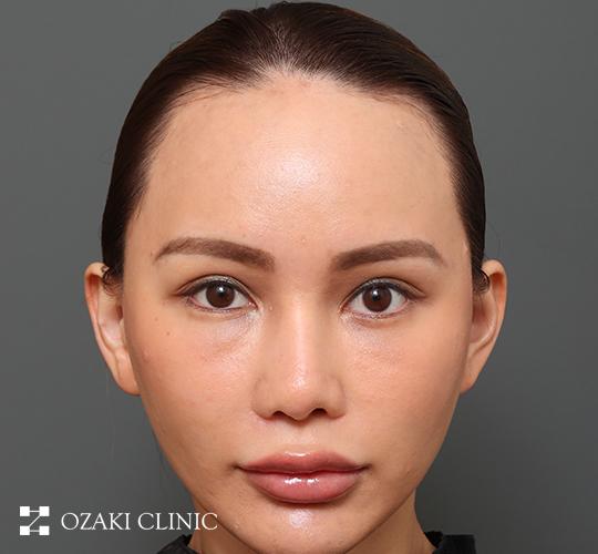 30代女性の額縮小 Before 症例写真