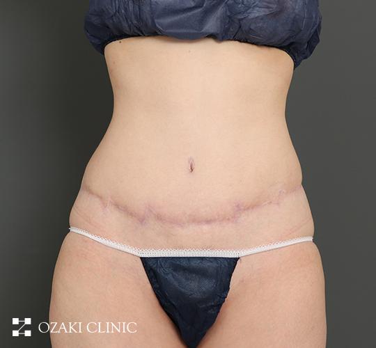 30代女性の外薗式タミータック（腹壁形成術） After 症例写真
