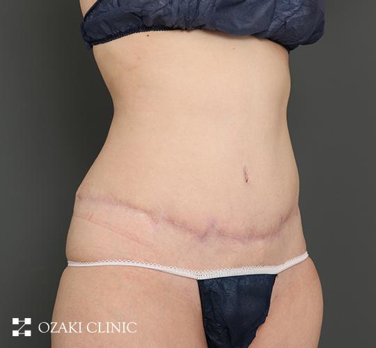 30代女性の外薗式タミータック（腹壁形成術） After 症例写真