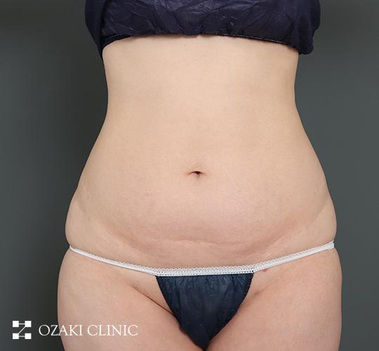30代女性の外薗式タミータック（腹壁形成術） Before 症例写真