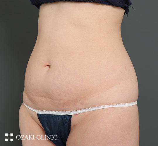 30代女性の外薗式タミータック（腹壁形成術） Before 症例写真