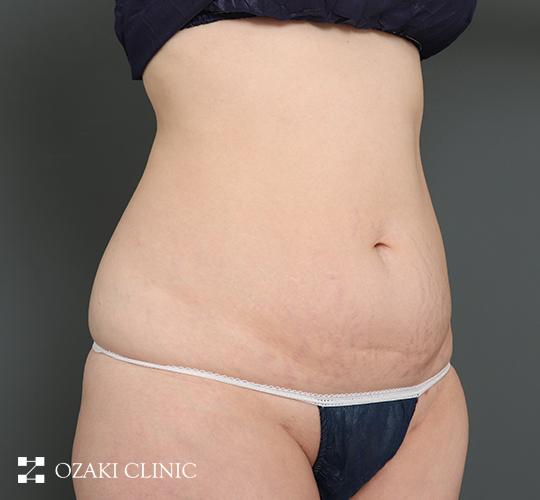 30代女性の外薗式タミータック（腹壁形成術） Before 症例写真