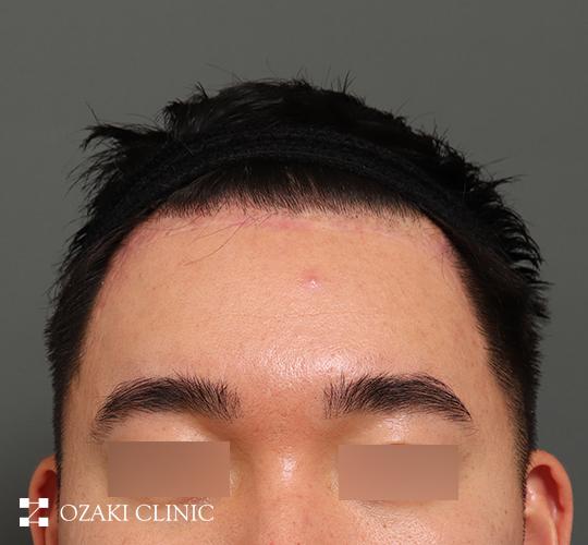 30代男性の額縮小 After 症例写真